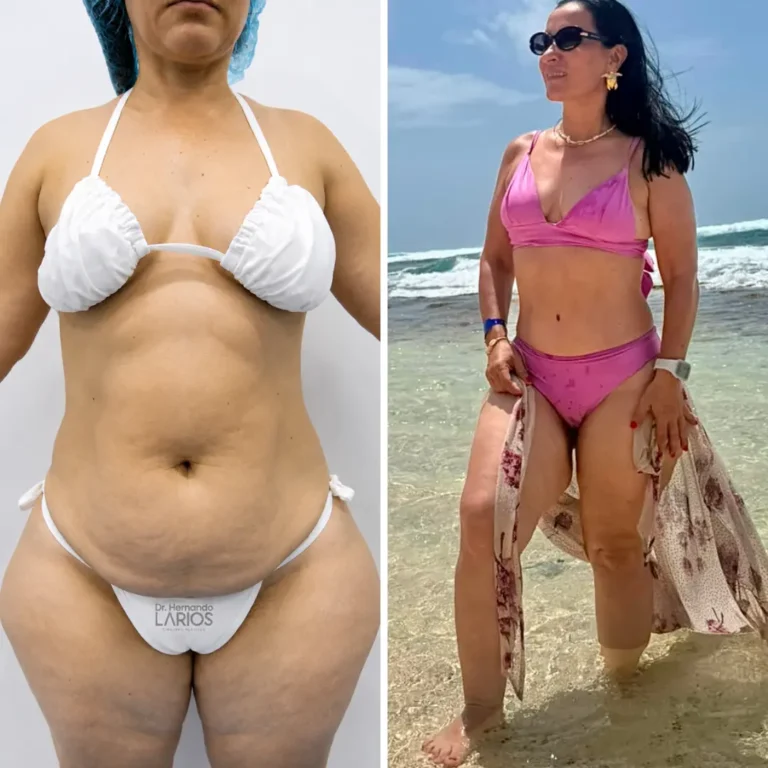 Abdomino + liposucción 360 - 3 años de evolución