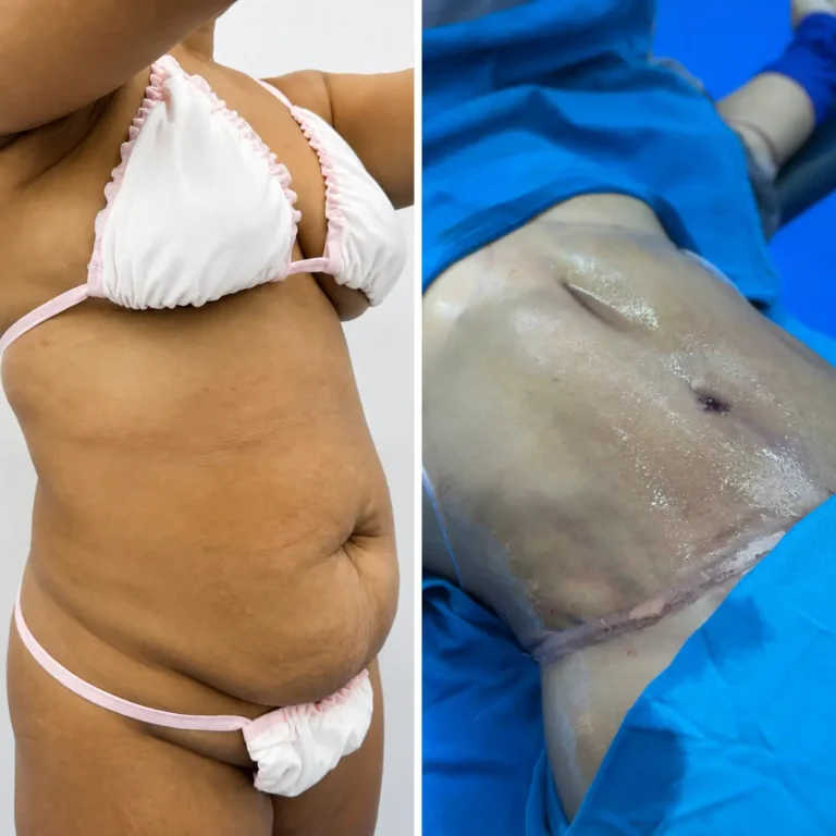 Abdominoplastia + liposucción 360 Resultado inmediato