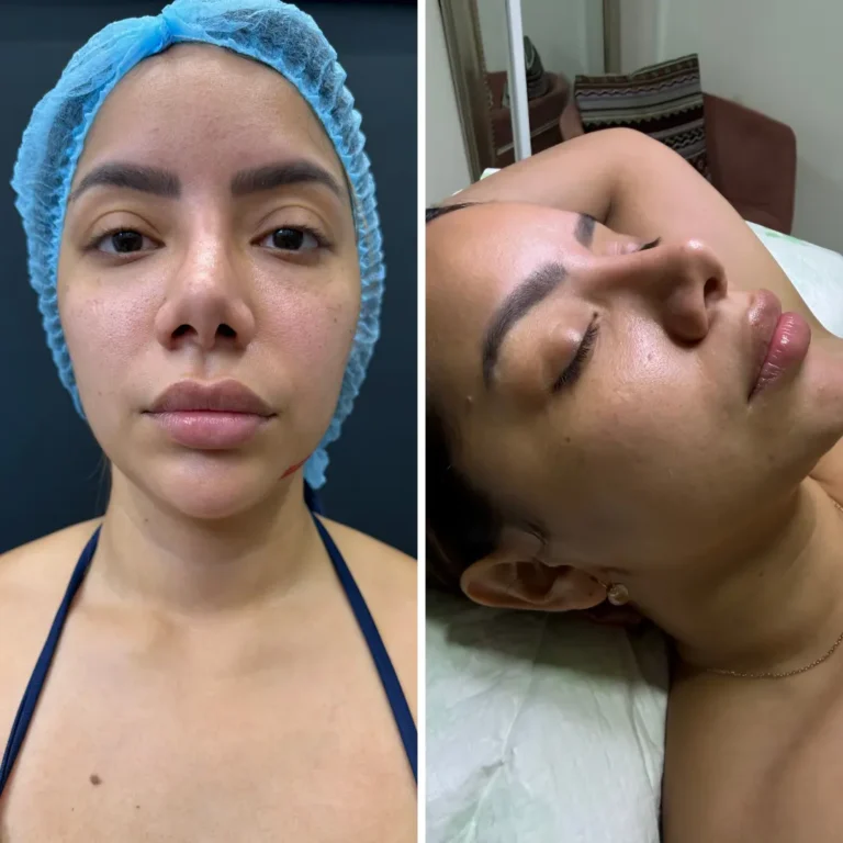 Lipo papada & perfilamiento facial - 3 meses evolución
