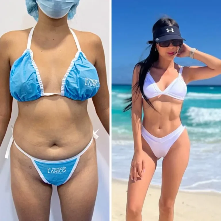 Liposuccion 360 + marcación abdominal + lipotransferencia glútea 6 meses de evolución