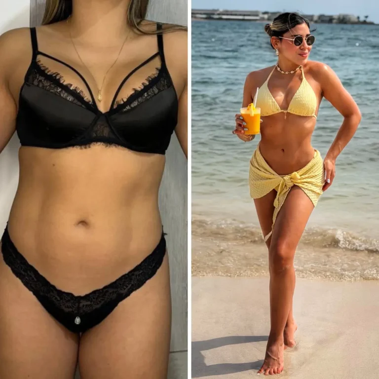 Liposucción + lipotransferencia glútea 3 años de evolución