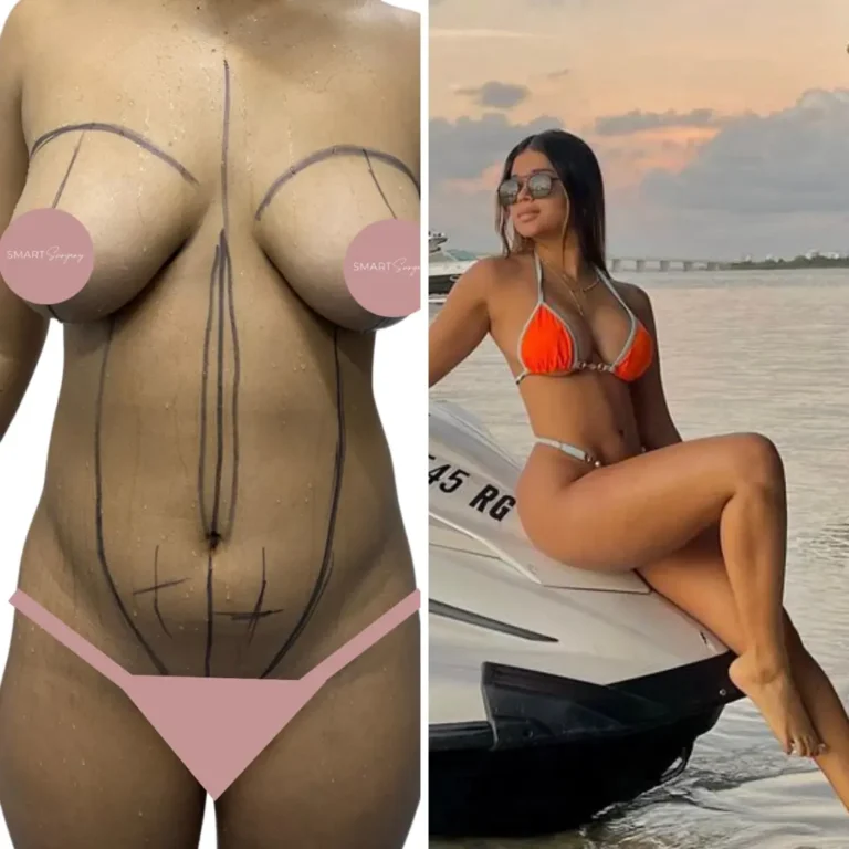 Mamoplastia+ Liposucción + lipotransferencia glútea 2 años de evolución