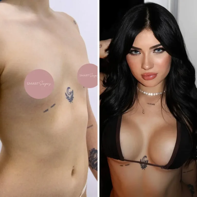 Mamoplastia aumento - 2 años de evolución