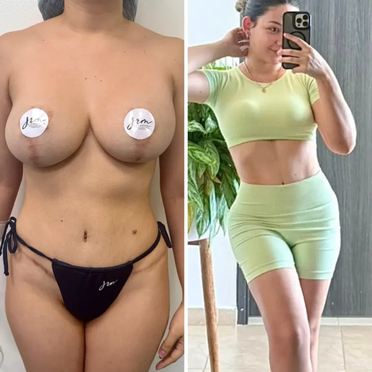 Mommy make over (cambio de implantes y reduccion mamaria) + liposucción 360 + abdominoplastia