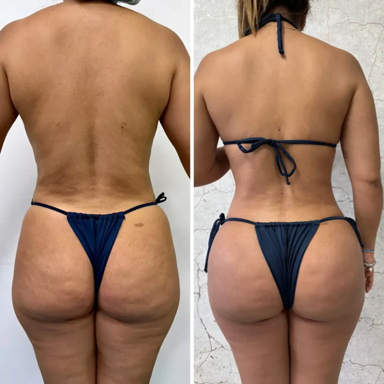 Pexia mamaria (reduccion y levantamiento con implantes) + liposucción 360 con Jplasma 1 mes de evolución (2)