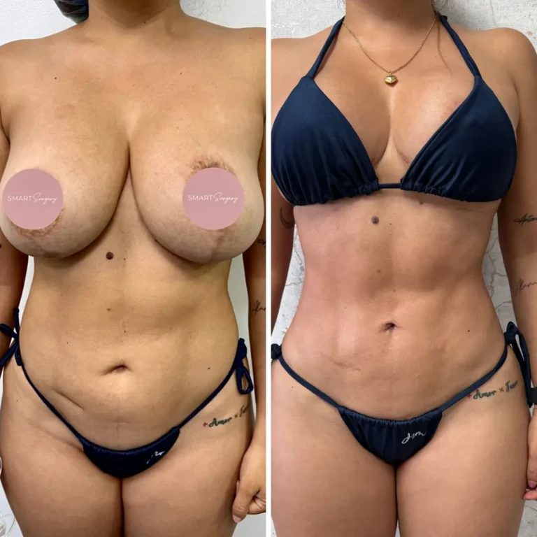 Pexia mamaria (reduccion y levantamiento con implantes) + liposucción 360 con Jplasma 1 mes de evolución