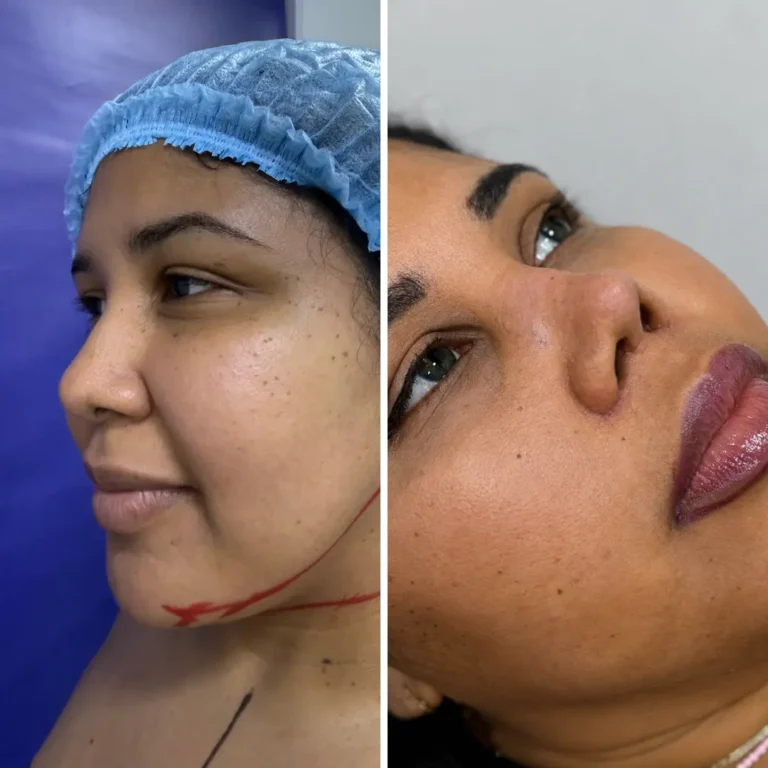 Rinoplastia Estetica + perfilamiento facial Resultado inmediato