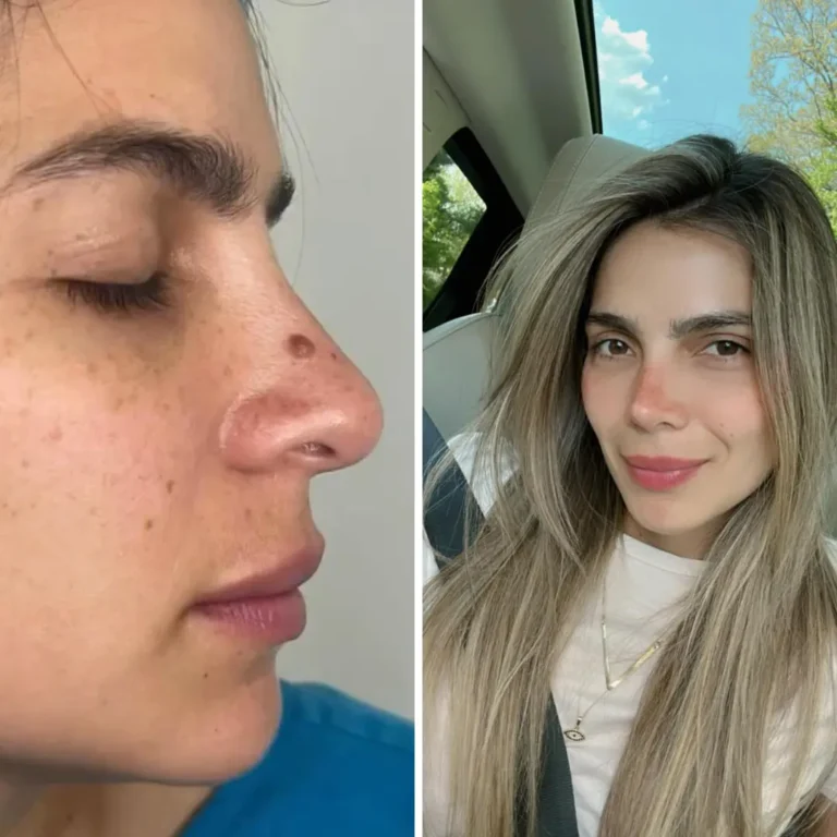 Rinoplastia Estetica y funcional 10 meses de evolución